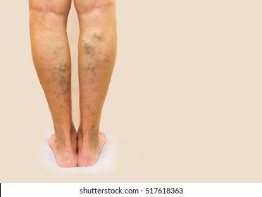 Varicele: cauze, simptome, solutii Postul cu picior varicos