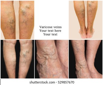 5 Ways To Treat Varicose and Spider Veins Fast Masi tablet varicose