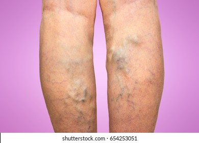 Varicose veins on a female legs