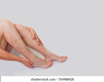 Varicose veins on a female legs. Phlebology  and DVT
