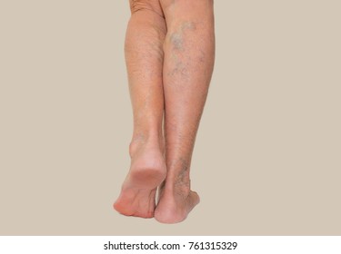 Varicose veins on a female legs. Phlebology  and DVT