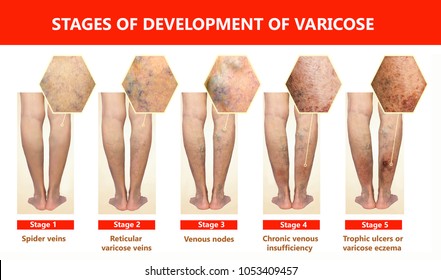 Varicose veins on a female senior legs. The stages of varicose veins. Phlebology. The old age and sick of a woman. Varicose veins on a legs of old woman. The varicosity, spider veins, edema, illness 