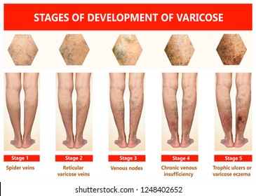 Varicose veins on a female senior legs. The stages of varicose veins. Phlebology  and DVT. Varicose veins on a legs of old woman. The varicosity, spider veins, edema, illness concept