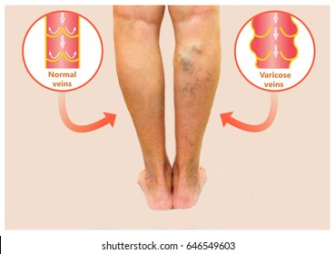 Umflarea gleznei cu vene varicoase Cum de a trata picioarele umflate de la varicoza