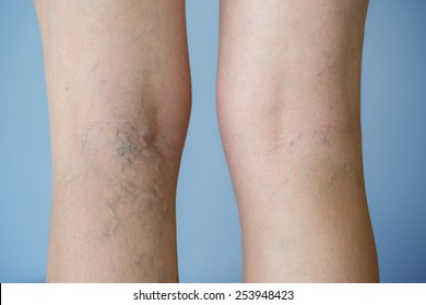 Varicose Veins On A Leg