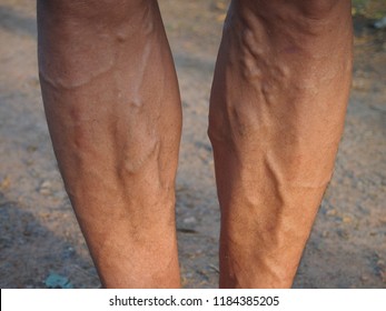 Varicose veins on the leg man using for health care concept.