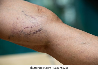 Varicose veins on a leg in Senior women
