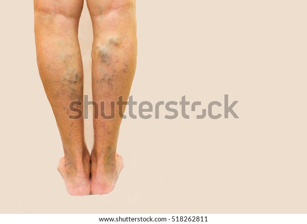 piernas de eccema varicoso