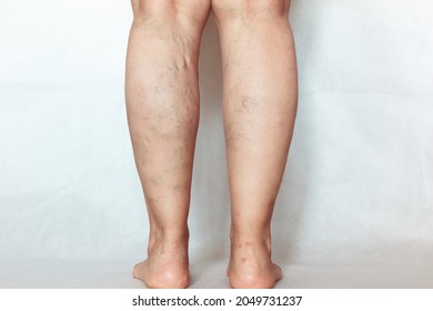 Varicose veins on the legs of an older woman. Phlebology and DVT. Aging, old age diseases, the concept of aesthetic problem.