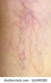 Varicose Veins On Skin Stock Photo 162490385 | Shutterstock