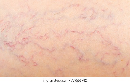 Varicose Veins On The Skin