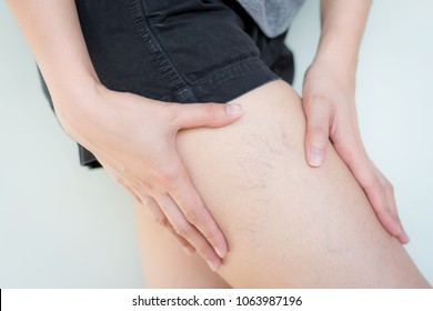 Varicose Veins On The Skin Of Leg