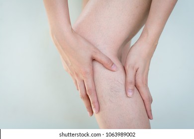 Varicose veins on the skin of leg
