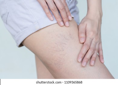 Varicose Veins On The Skin Of Leg