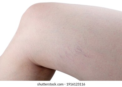 Varicose veins on the skin of leg. Isolated on white background.