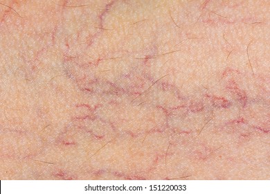 Varicose Veins On The Skin. Macro