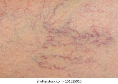 Varicose Veins On The Skin. Macro