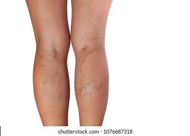 Varicose veins on woman legs