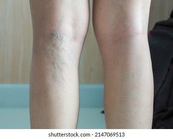 Varicose veins on a woman's leg Vascular disease, varicose veins problem, life concept. health care