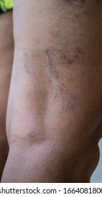 Varicose Veins On Young Women Legs