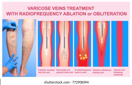 Varicose Veins and Treatment with radiofrequency ablation. Phlebology  and DVT
