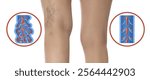 Varicose veins. Woman showing legs on white background, closeup. Illustrations of damaged and healthy vein, longitudinal section