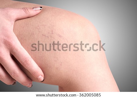 varicose veins in women