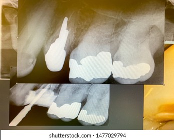 Various X-ray Recording Of Teeth Are Available At The Dentist. Concept: Oral Care And Prevention