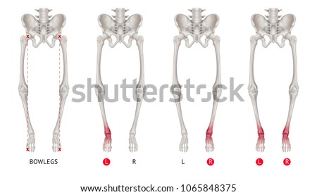 Varus alignment of leg or Bowlegs bone collection with red highlights on Ankle joint pain area-Healthcare-Human Anatomy and Medical concept-Isolated on white background.