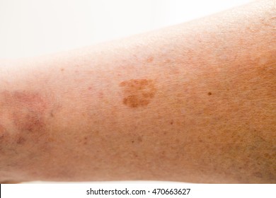 Vascular Birthmark