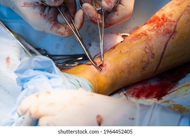 Vascular Surgeon Is Removing Veins For Varicose Surgery