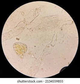 Vegetable cell and fungal septate hyphae of stool analysis under microscope, fecul vegetable cell
