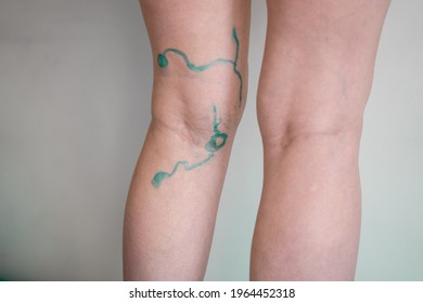 Vein Markup. Vascular Surgeon Is Marking Veins For Varicose Surgery.