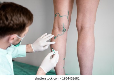 Vein Markup. Vascular Surgeon Is Marking Veins For Varicose Surgery.