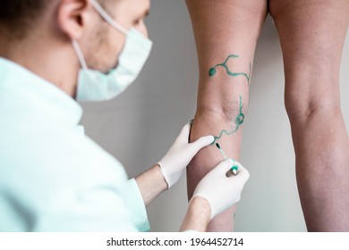 Vein Markup. Vascular Surgeon Is Marking Veins For Varicose Surgery.