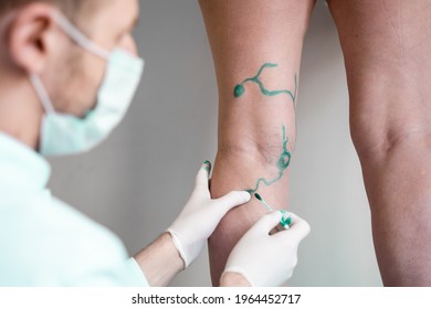 Vein Markup. Vascular Surgeon Is Marking Veins For Varicose Surgery.