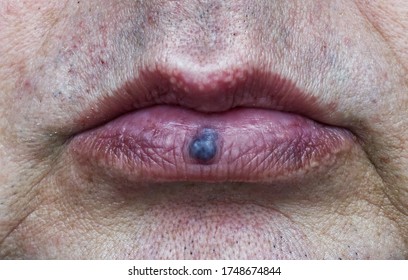 Venous lake of the lower lip of mouth. Healthcare and medical concept.
