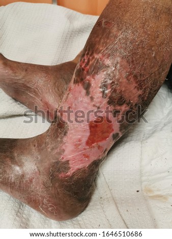 Venous Ulcer with hypopigmentation and oedema.