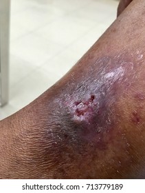 Venous Ulcer In The Legs