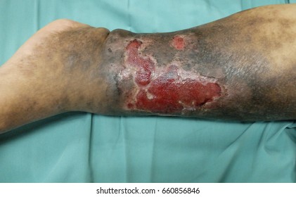 Venous Ulcer with Lipodermatosclerosis.Healing ulcer with healthy granulation tissue noted.
Four layers compression bandage has been applied on this patient.