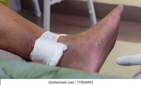 Venous ulcer or varicose ulcer in healing phase wirh gauze covered at the medial side of leg.
