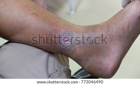 Venous ulcer or varicose ulcer ib healing phase at the medial side of leg.