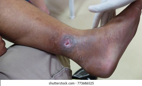 Venous ulcer or varicose ulcer at the medial side of leg.