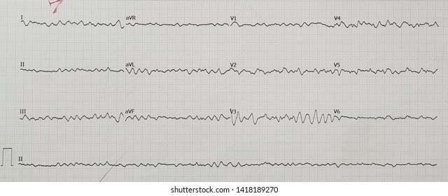 Ventricular Arrhythmia (VF) From STEMI.