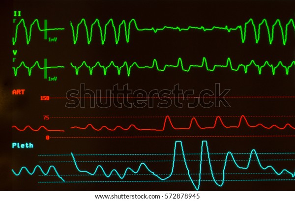 緑線上の心室頻拍と心室内伝導遅延 赤線上の動脈血圧 黒スクリーンのモニター上の青線上の酸素飽和またはプレツスモグラフィー の写真素材 今すぐ編集