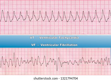 Ventricular Tachycardia (VT) -  is fast heart rhythm, that originates in one of the ventricles of the heart. Ventricular Fibrillation (VF) - is a cause of cardiac arrest and sudden death. 
