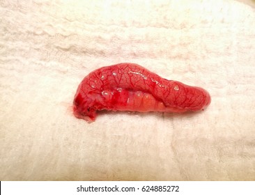 Vermiform Appendix After Surgery Of Appendicitis 