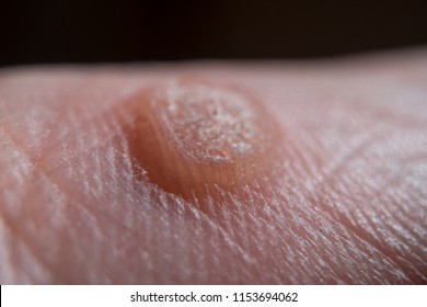 Verruca On Hand Moles Freeze Concept Stock Photo (Edit Now) 1153694062