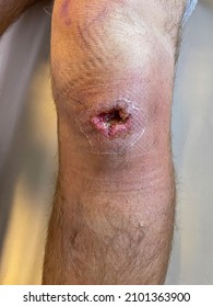 VERTICAL, CLOSE UP: Drainage surgery leaves a grown male with an open hole in his knee. Detailed close up shot of a young man's open wound after abscess drainage. Emergency room infection treatment.