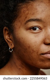 Vertical macro shot of acne scars on face of young black woman looking at camera